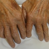 Artrite reumatóide sintomas e tratamento