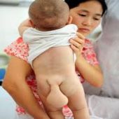 Bebê nasce com cauda na China